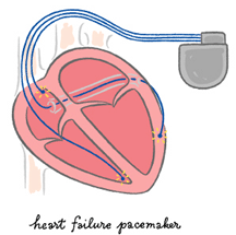 heart failure pacemaker